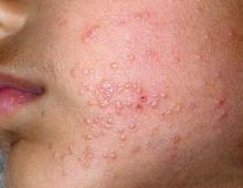 Skin manifestations of HIV infection and AIDS